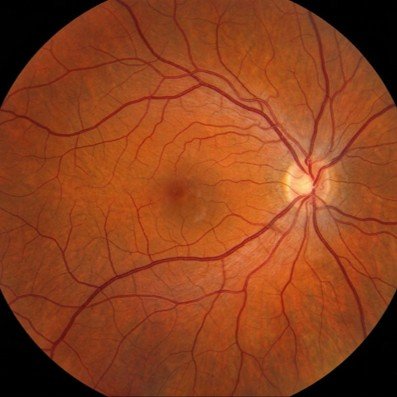 Mapeamento de retina (exame do fundo de olho)