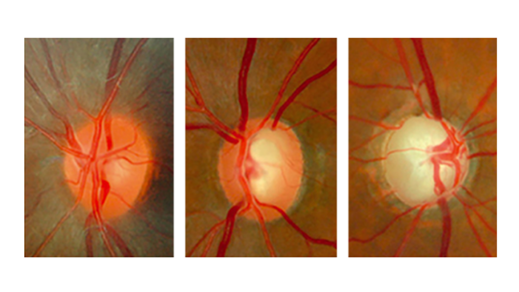 Glaucoma — nervo óptico afetado, oftalmologista em Alphaville