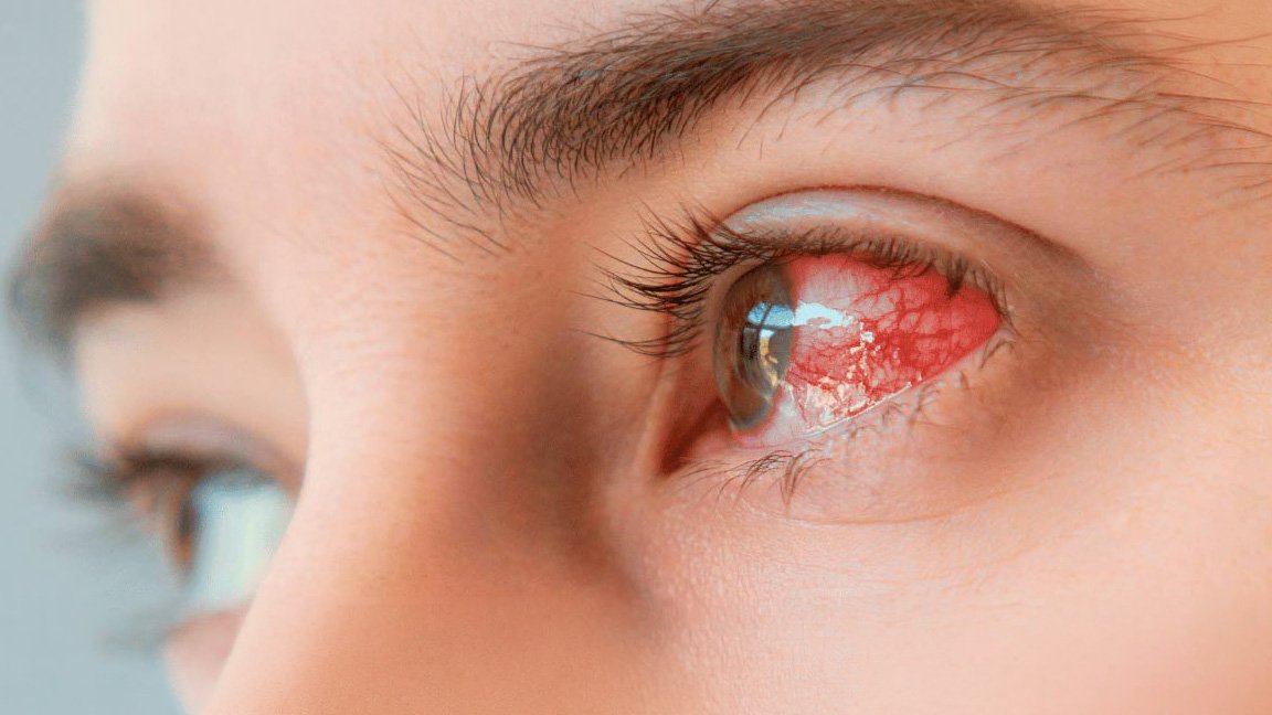 Olho vermelho — hiperemia conjuntival, causas e tratamento em Alphaville